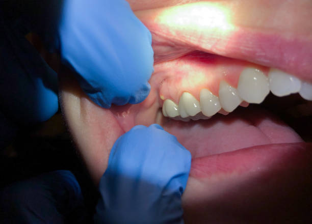 Best Emergency Denture Repair in Walnut, IL